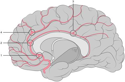 Endovascular treatment of distal anterior cerebral artery aneurysms using flow modulation devices: mid- and long-term results from a two-center study